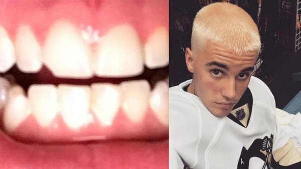 Justin Bieber bị mẻ răng