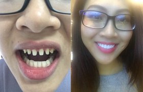 Sau phát ngôn so sánh của Lê Âu Ngâu Anh nếu tháo hết răng sứ thì liệu có ai dám nhìn Nguyễn Thị Thành khi cười không?