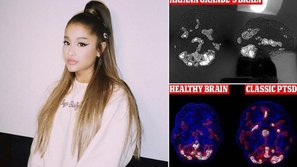 Chứng bệnh đáng sợ đang dần hủy hoại bộ não của Ariana Grande