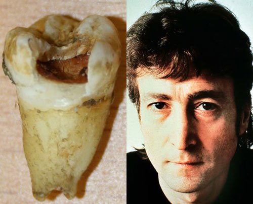 John Lennon: Răng sâu