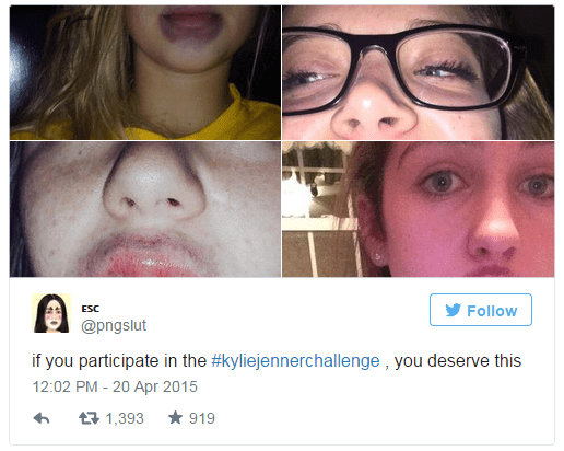 Kylie Jenner: Bơm môi